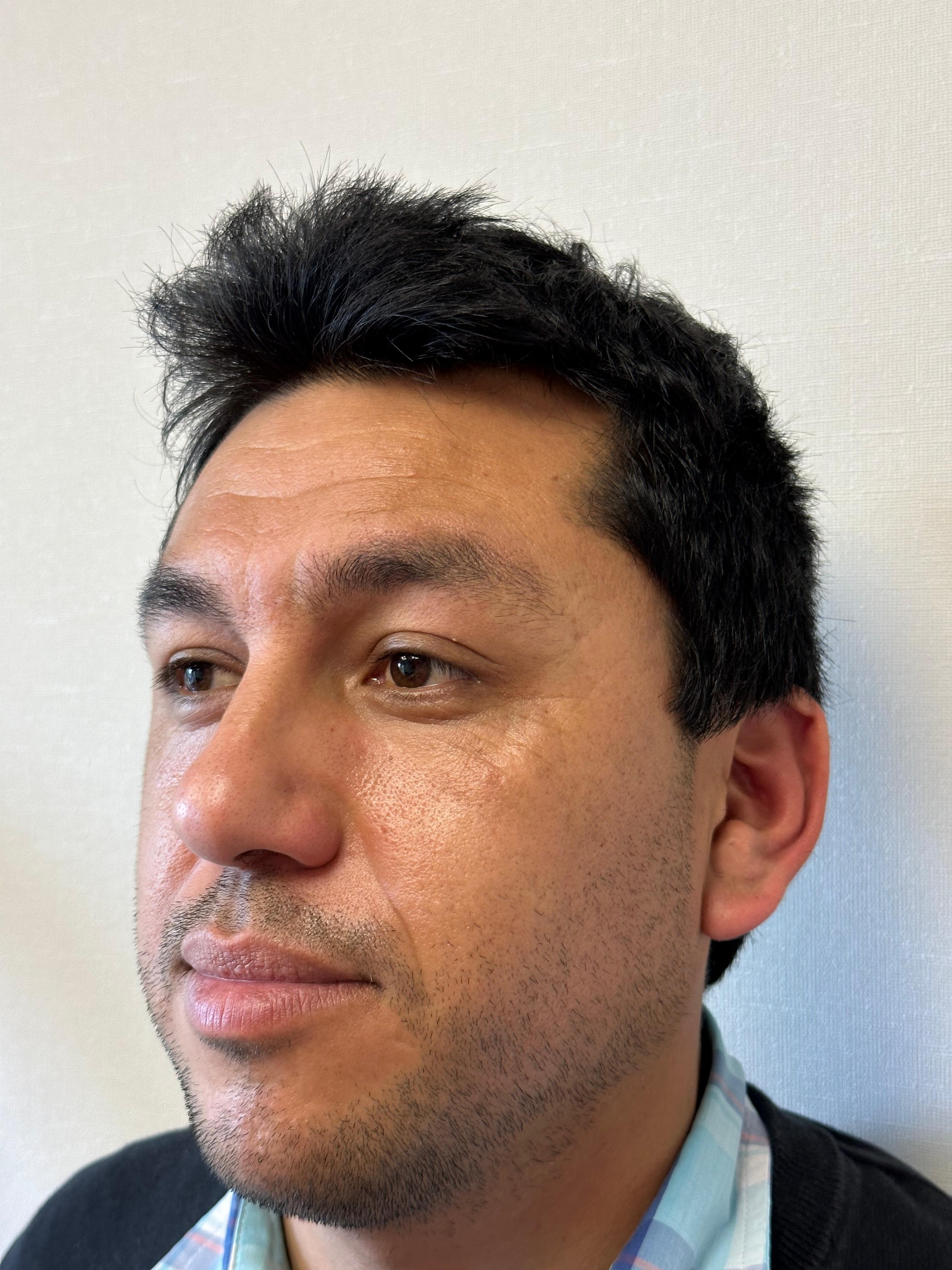 Recuperación capilar resultado