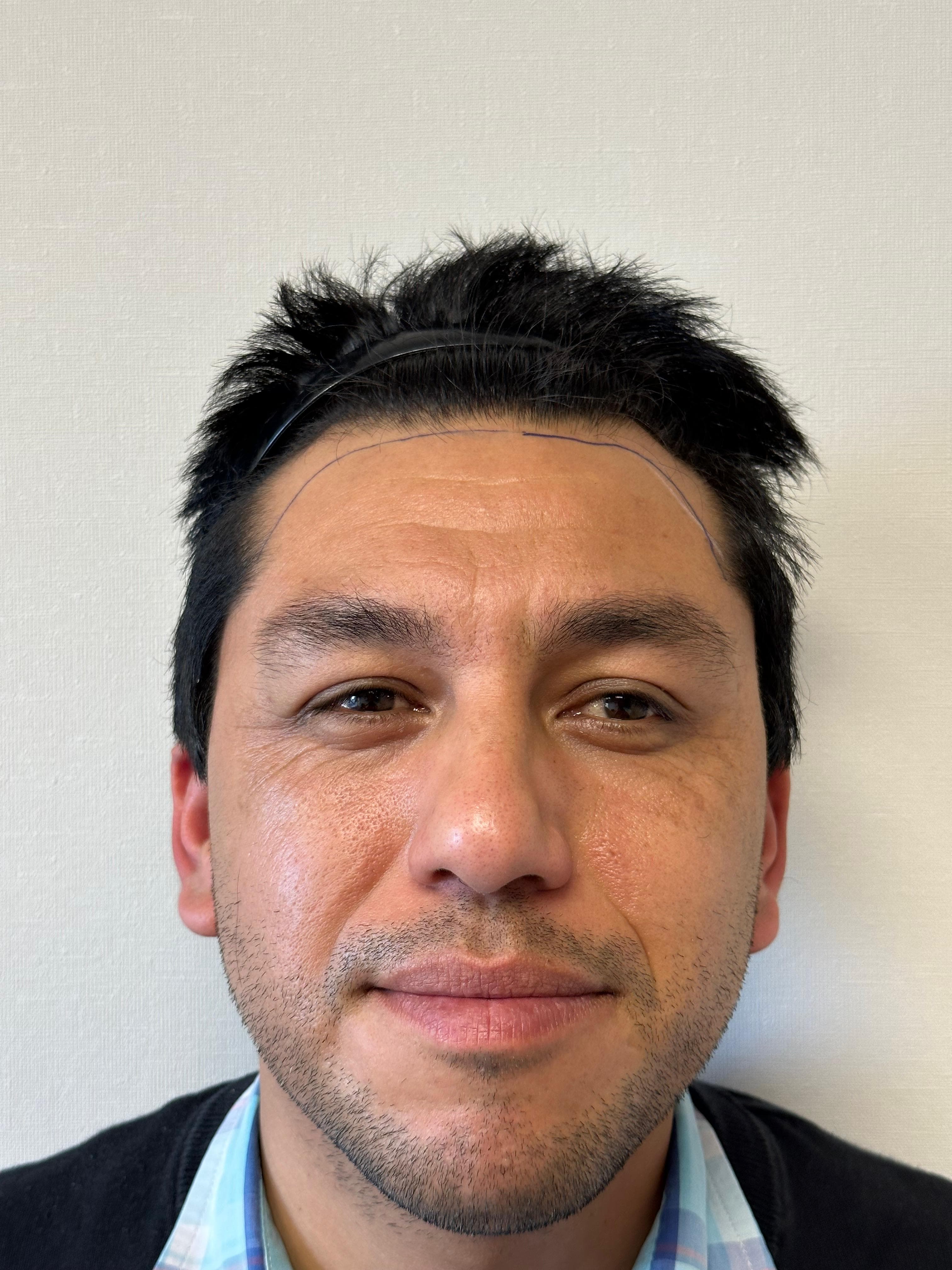 Antes y después capilar