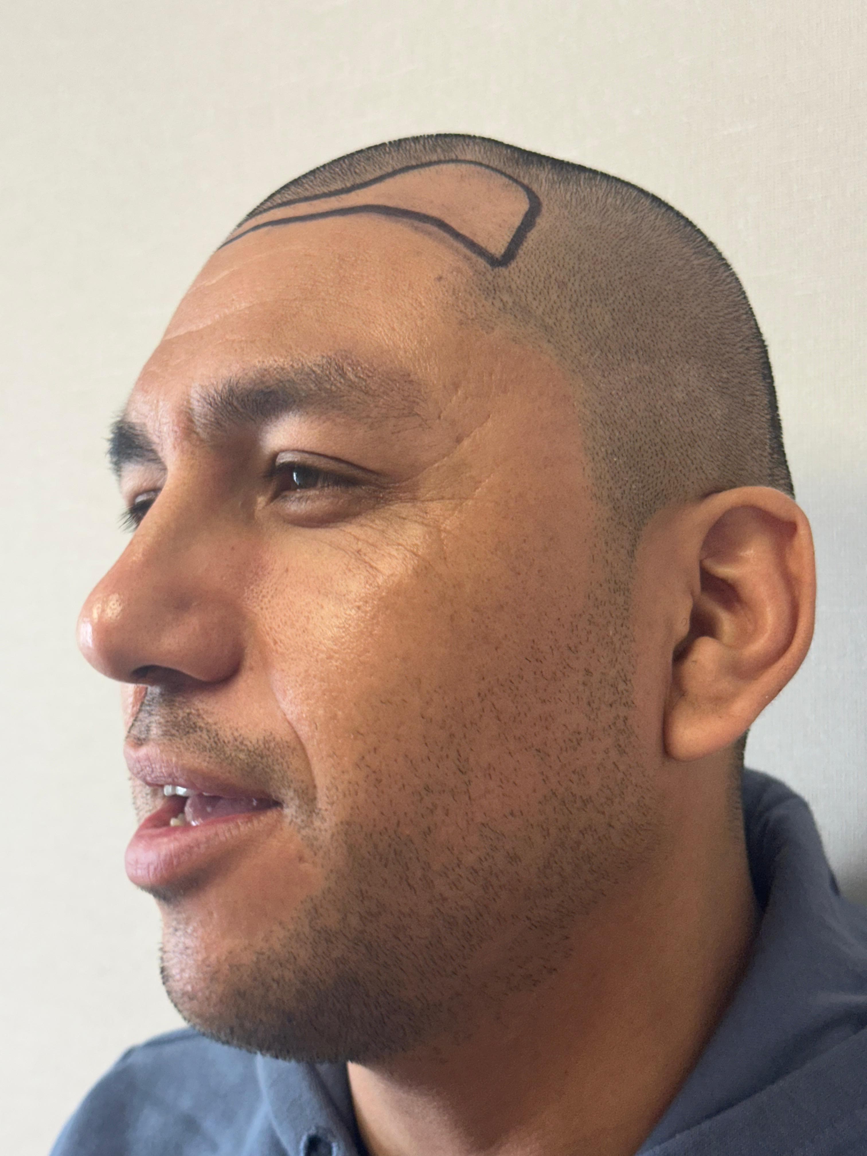 Técnica FUE detalle