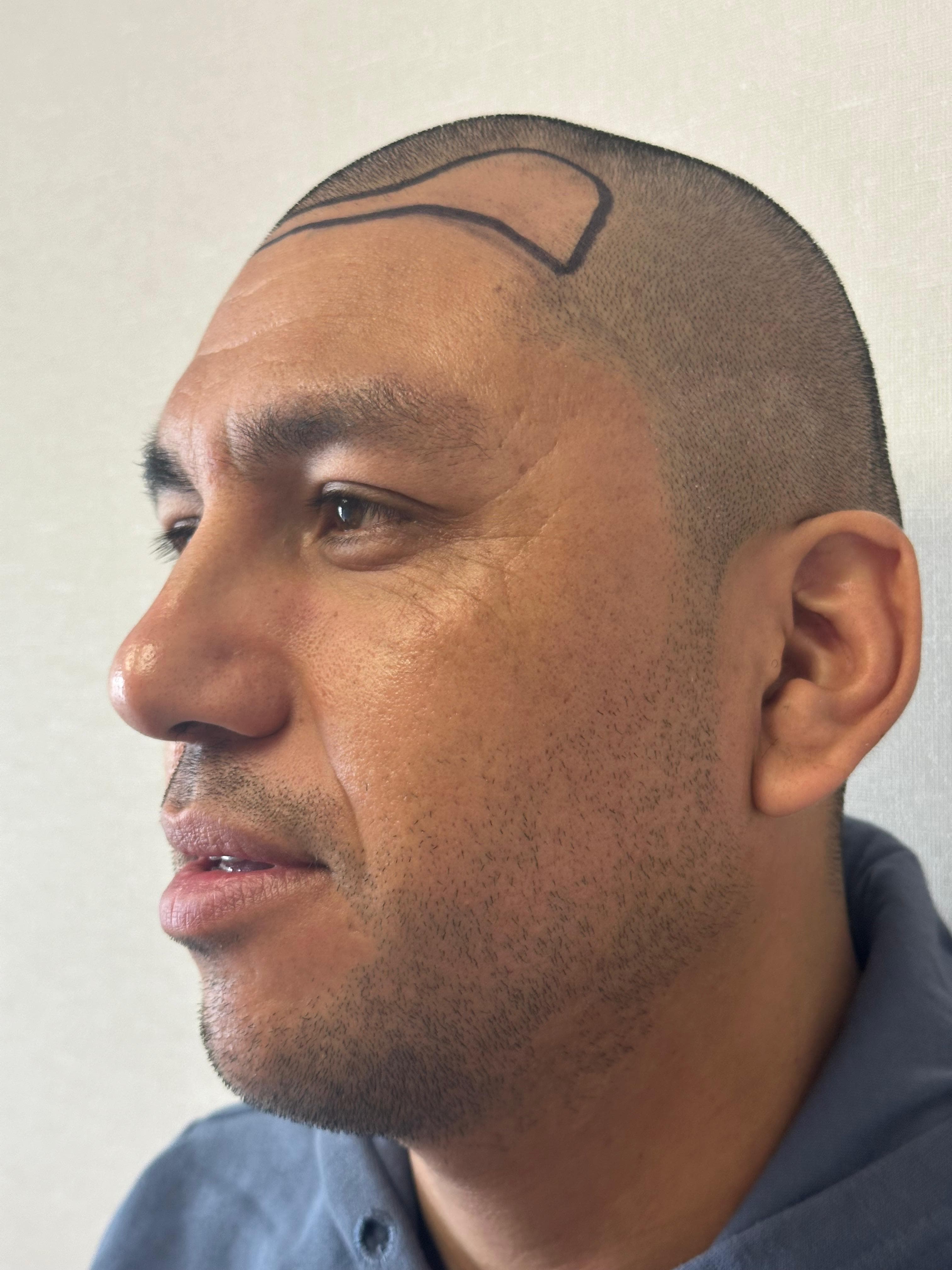 Recuperación capilar avanzada