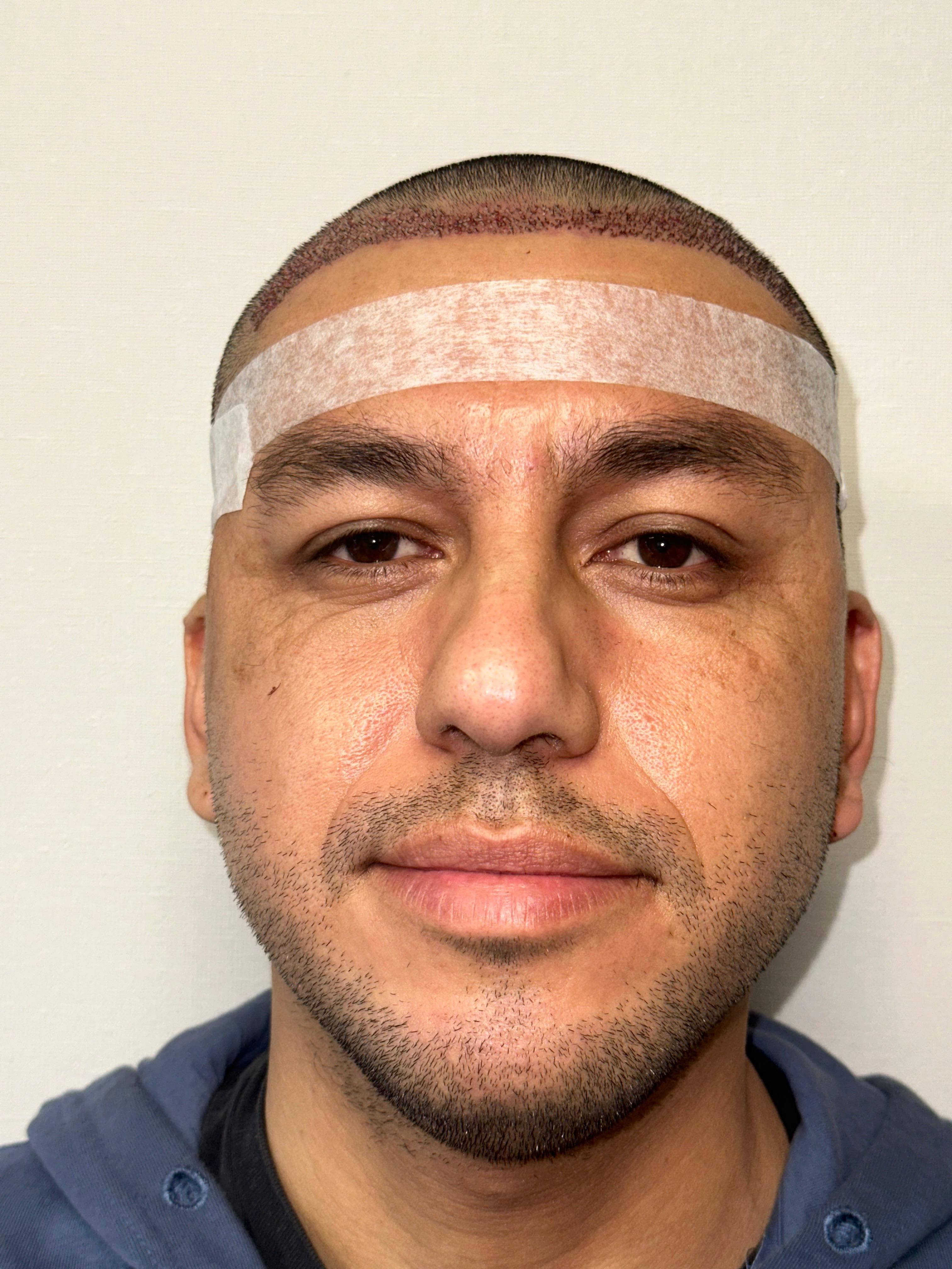 Procedimiento capilar