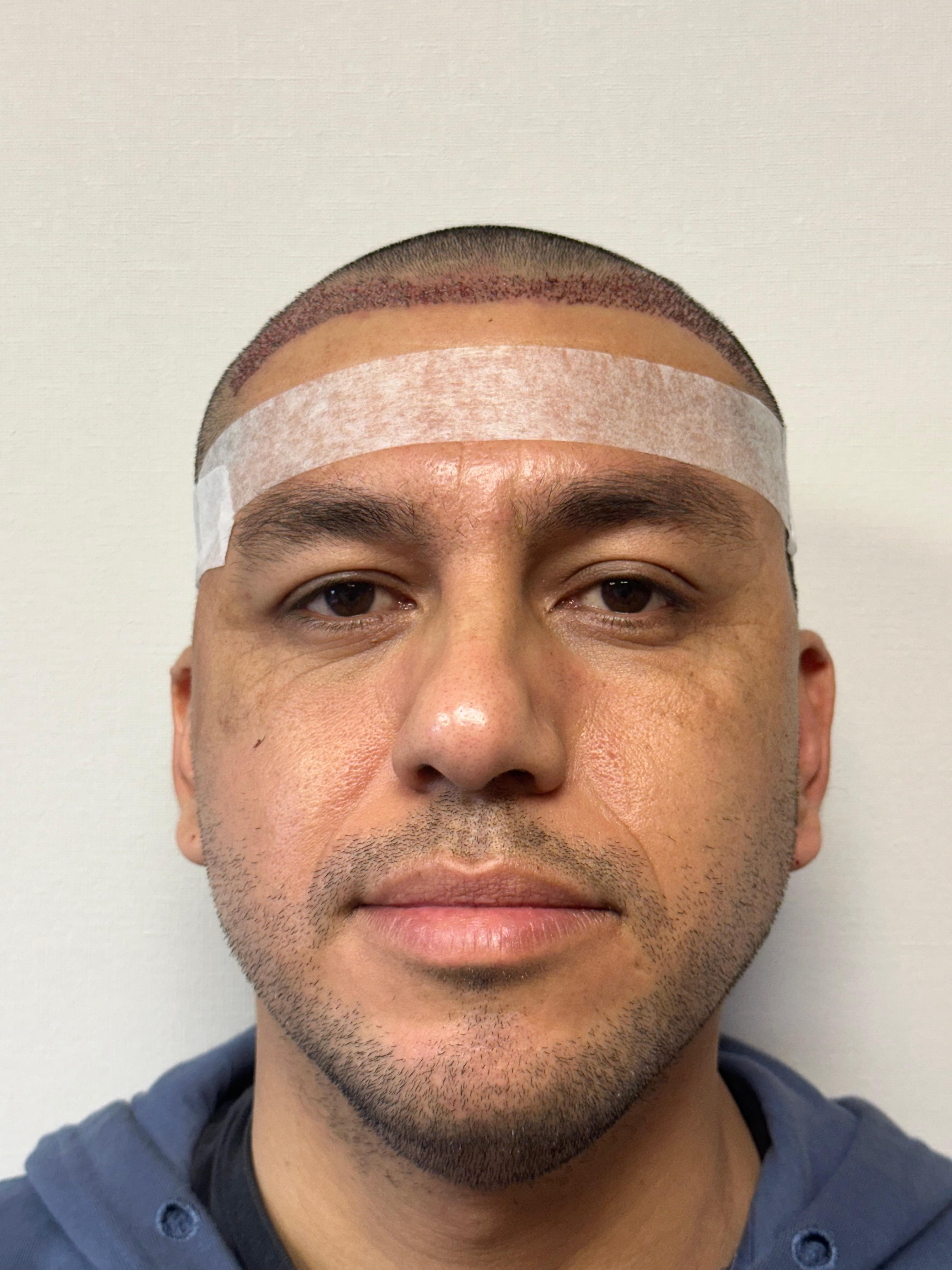 Detalle implante FUE