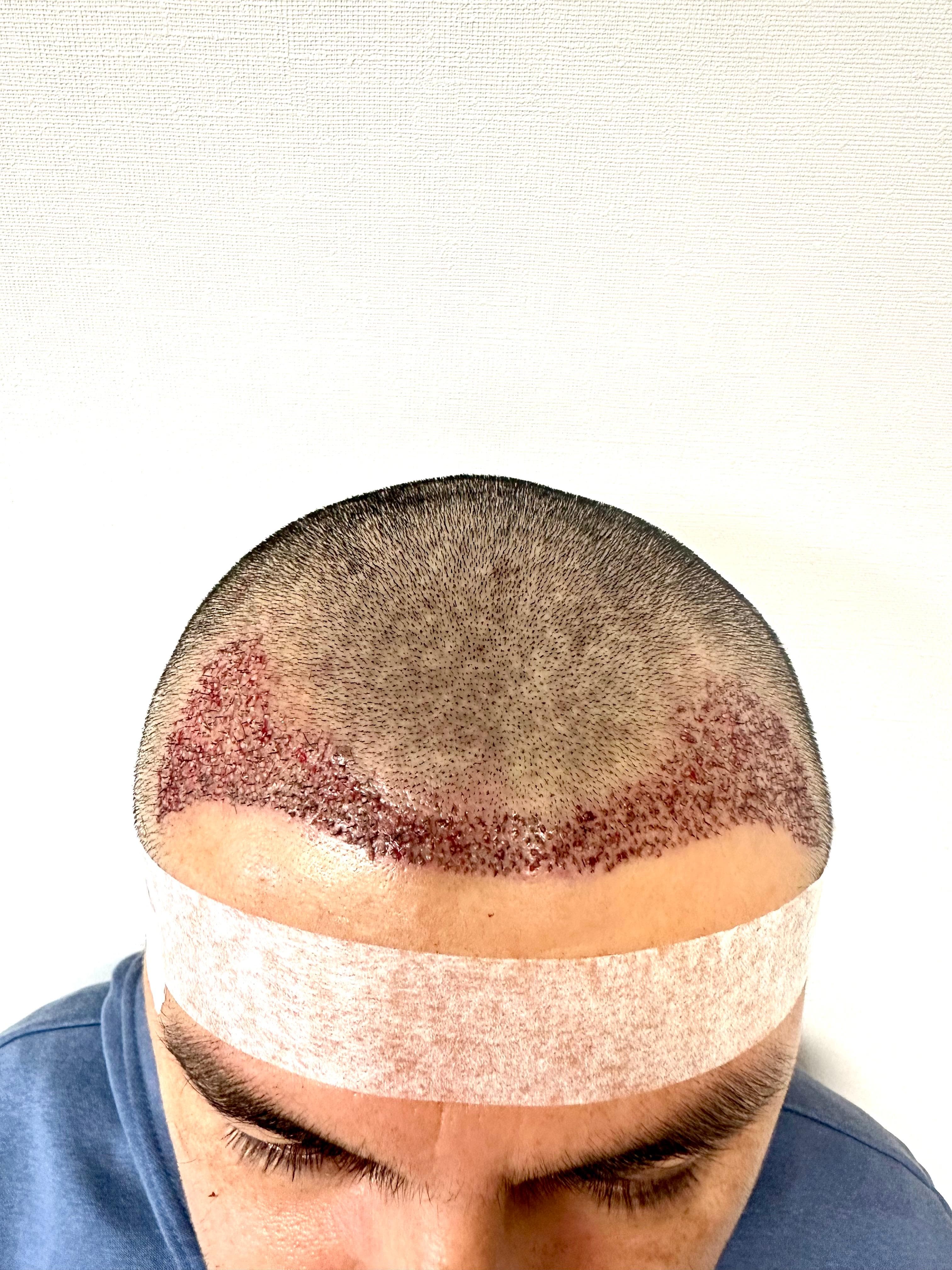 Caso clínico capilar