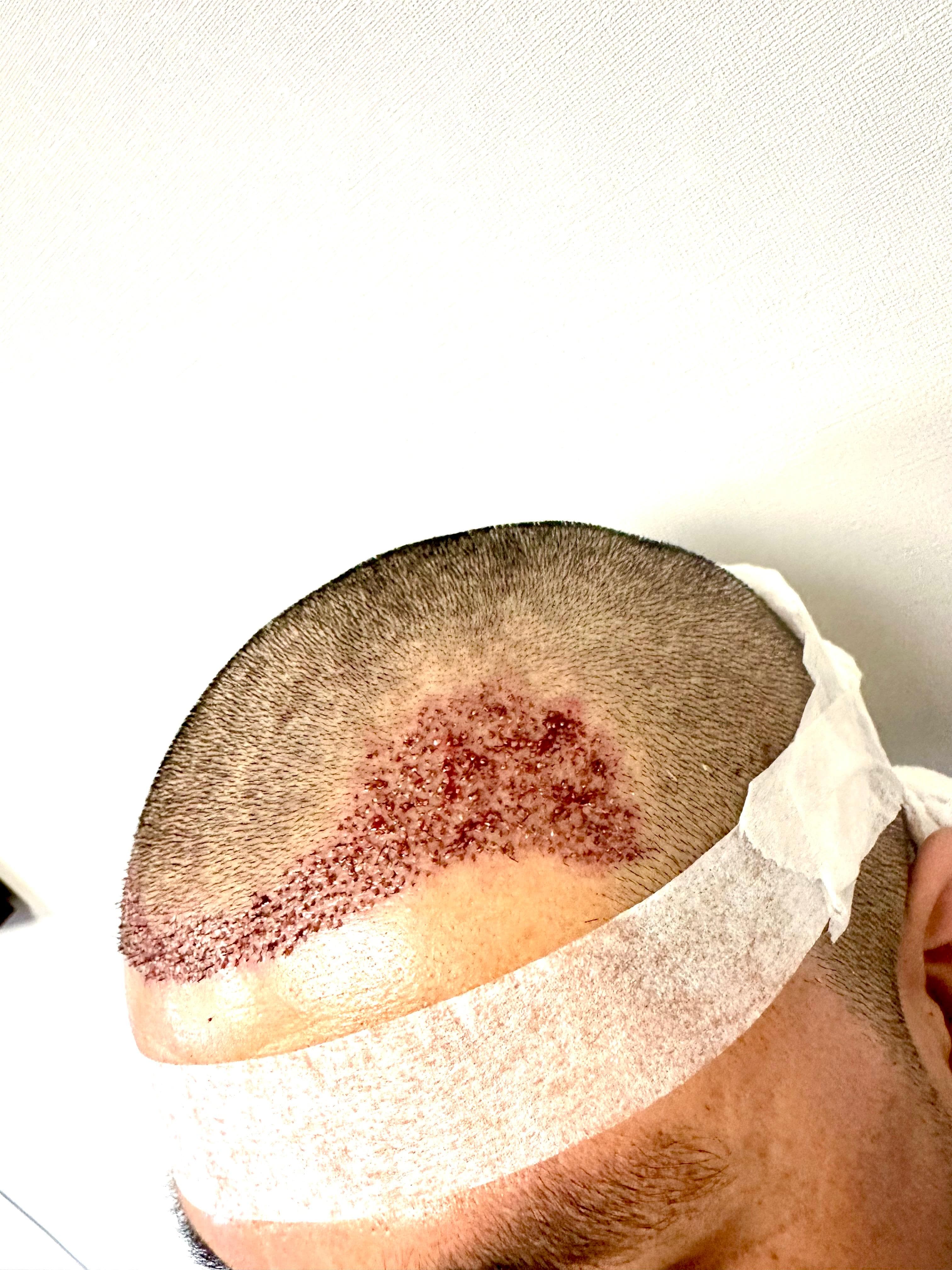 Evolución caso capilar