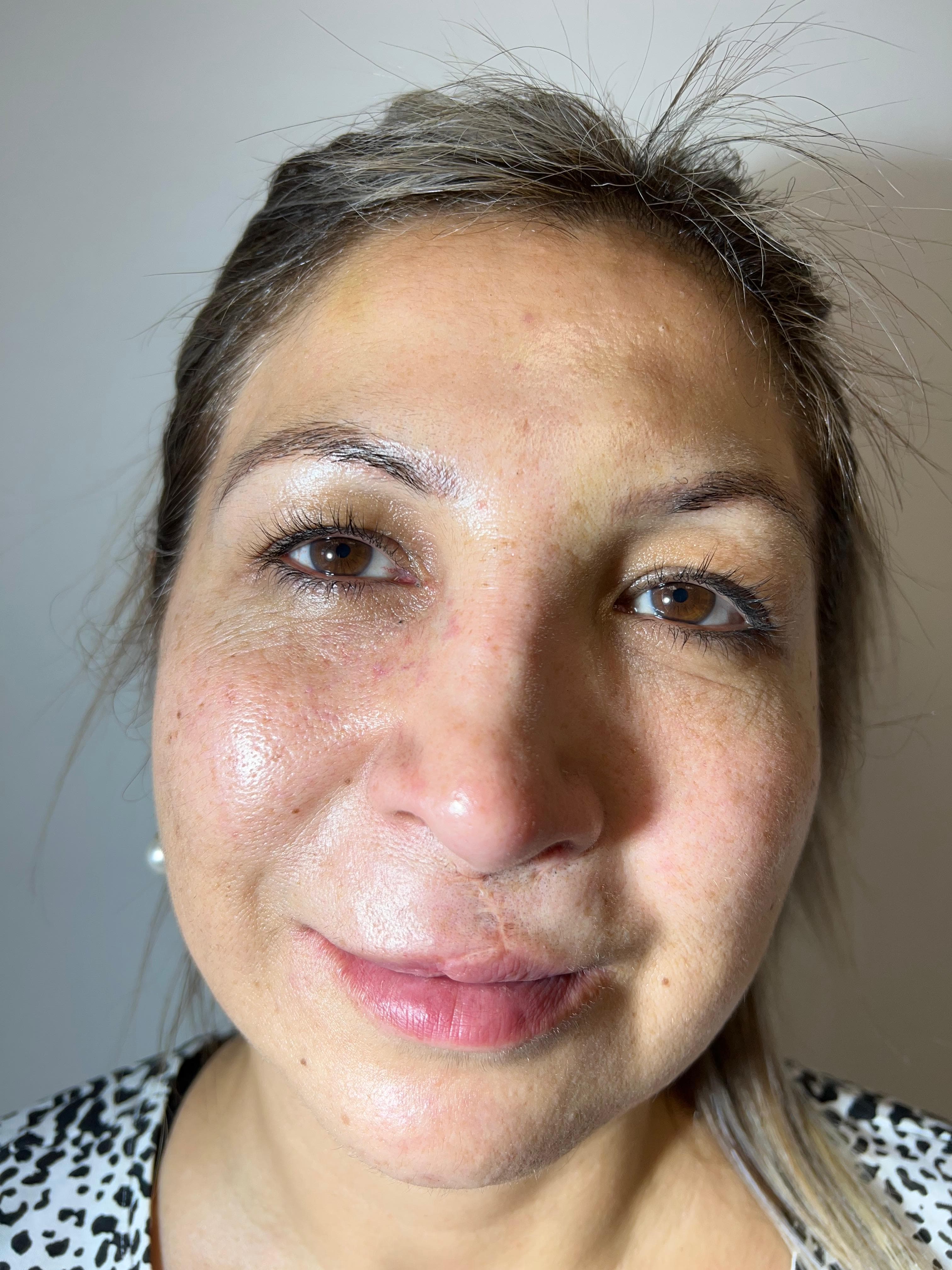 Resultado tratamiento estético