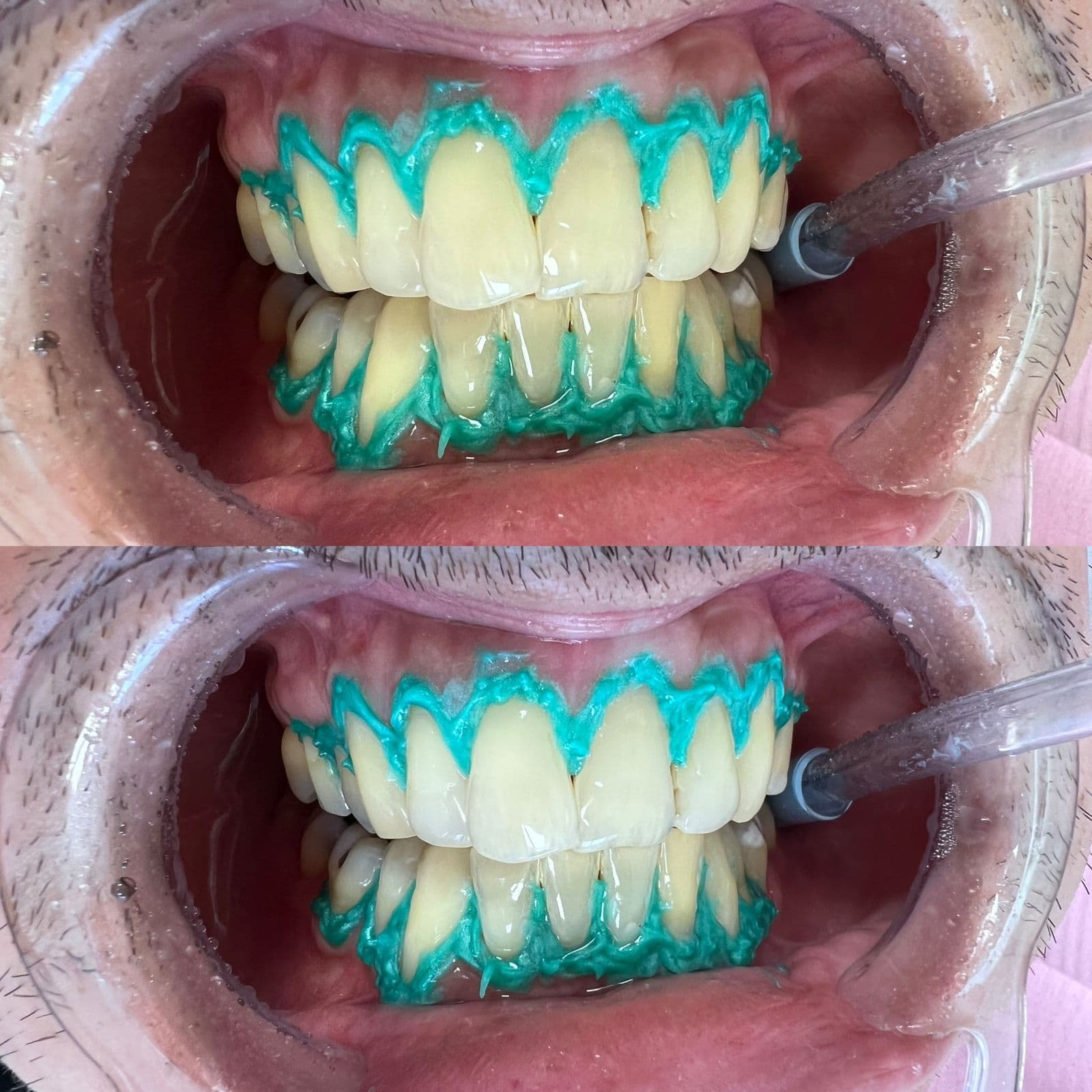 Procedimiento dental