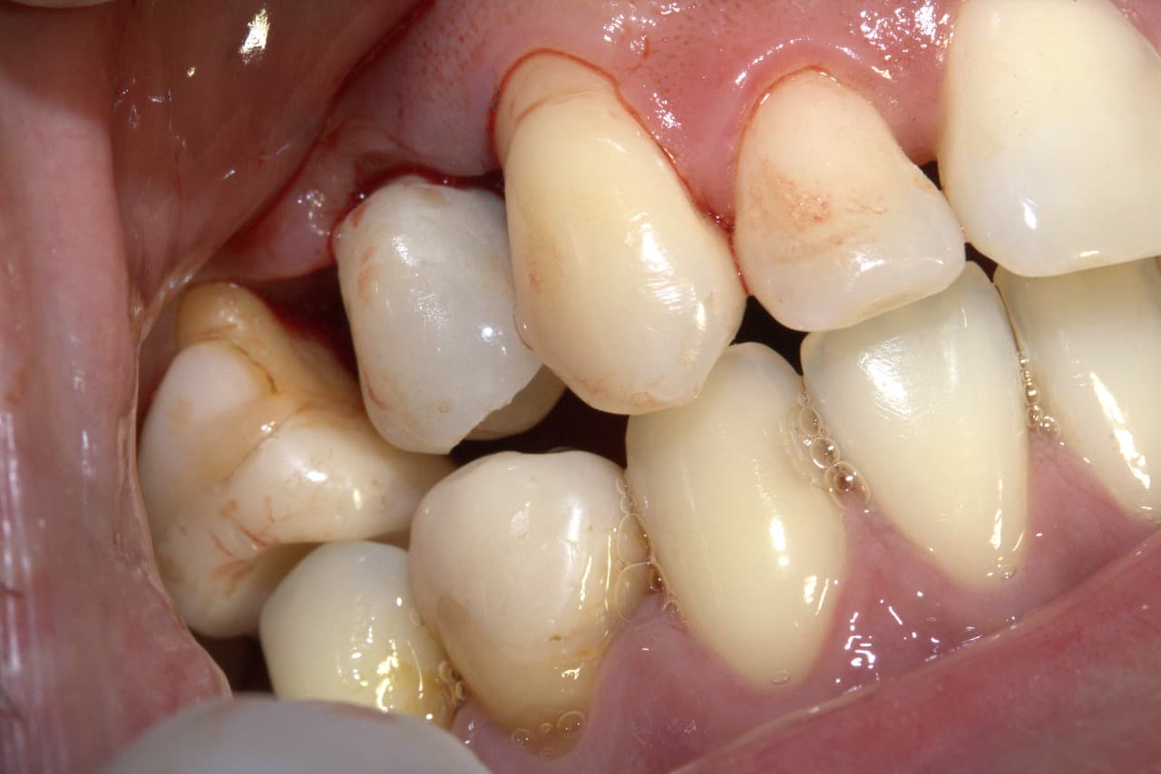 Caso dental avanzado