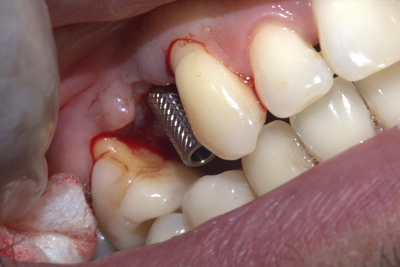 Resultado blanqueamiento