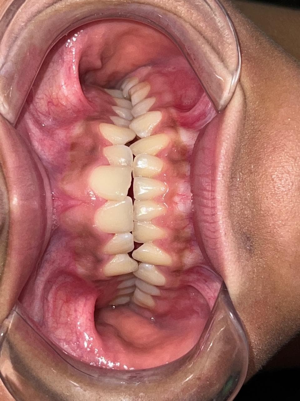 Tratamiento reciente