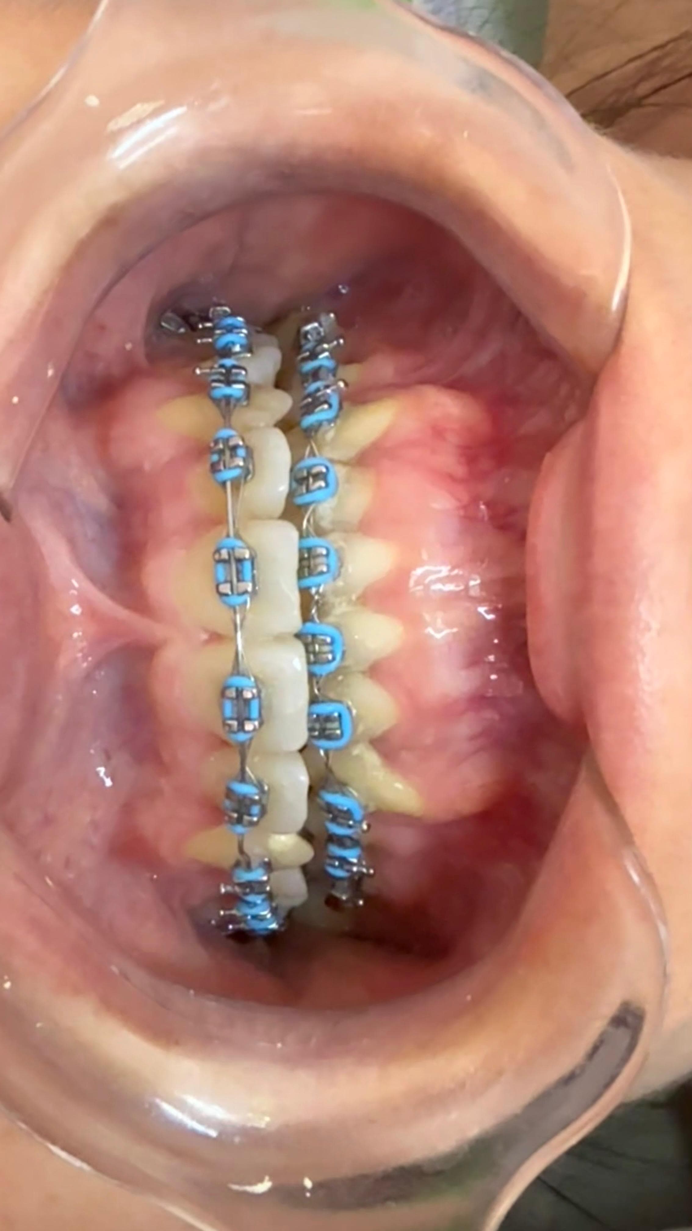 Procedimiento avanzado