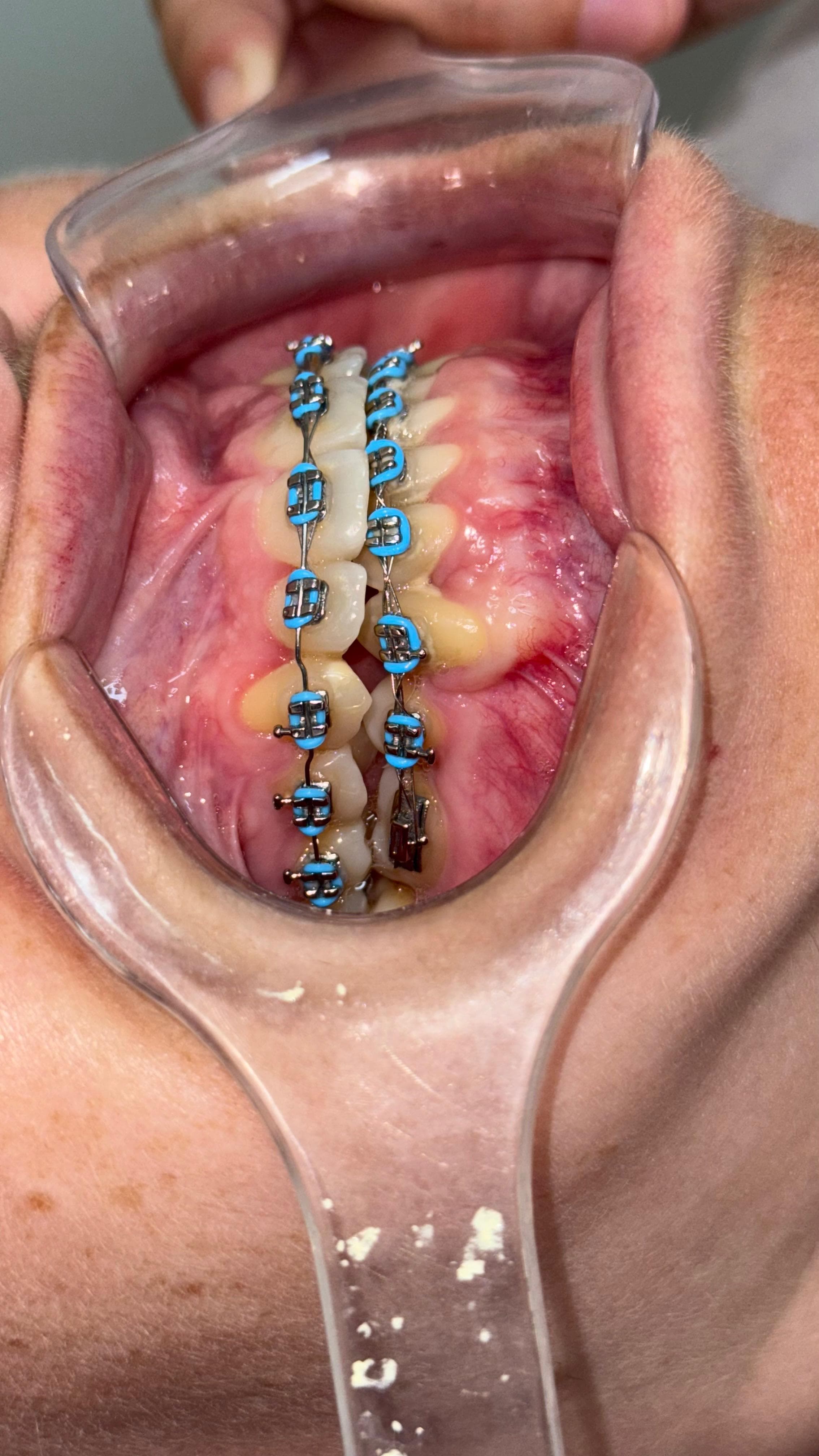 Resultado final dental